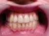 Воспаление слизистой оболочки рта: симптомы и лечение