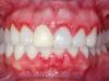 Воспаление десны около зуба: лечение и профилактика