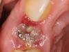 Лечение воспаления десны после удаления зуба