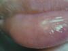 Изменения слизистой оболочки рта при аллергических заболеваниях