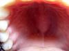 Болит нёбо во рту: каковы причины и лечение