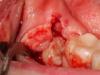 Рекомендации после удаления зуба: когда можно кушать, чистить зубы