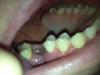 Удаление зуба: как убрать отек