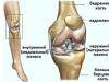 Травмы мениска коленного сустава: лечение без операции в домашних условиях, группы риска и виды повреждений Что мениск коленного сустава симптомы