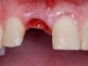 Удаление зуба: что делать после?