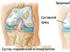 Артрит коленного сустава - симптомы и лечение заболевания