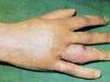 Панариций на пальце — причины возникновения, симптомы, диагностика, лечение и профилактика