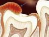 Воспаление капюшона зуба мудрости: причины, лечение