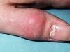 Как лечить панариций на пальце: самые эффективные методы лечения