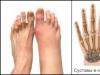 Артрит пальцев ног симптомы и лечение медикаментами